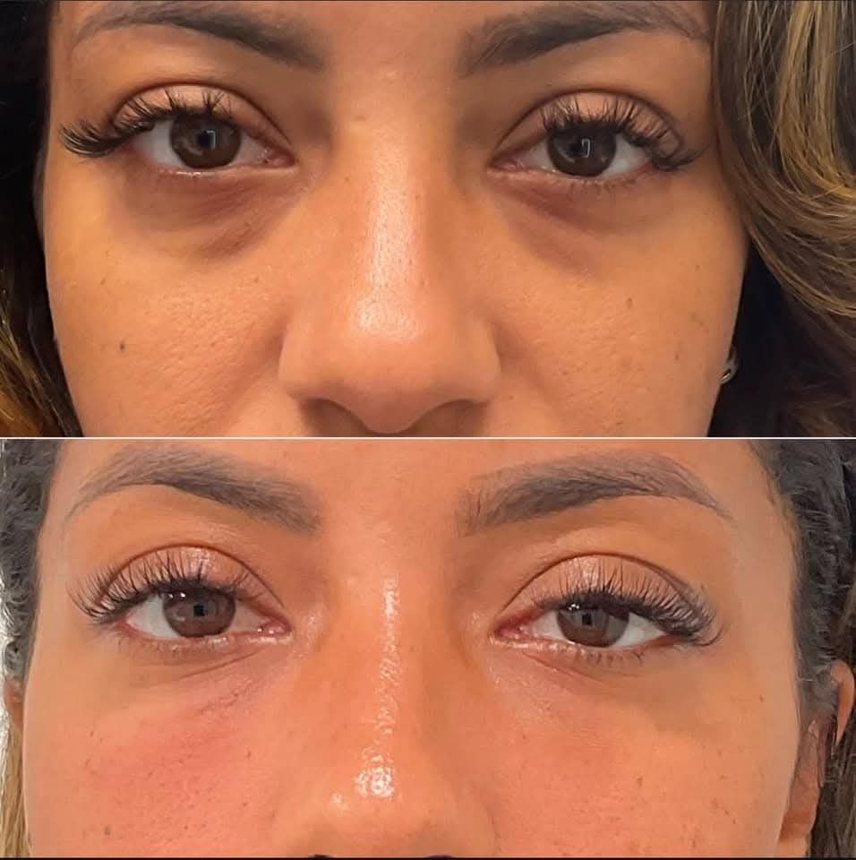 Versox ® Antiojeras
